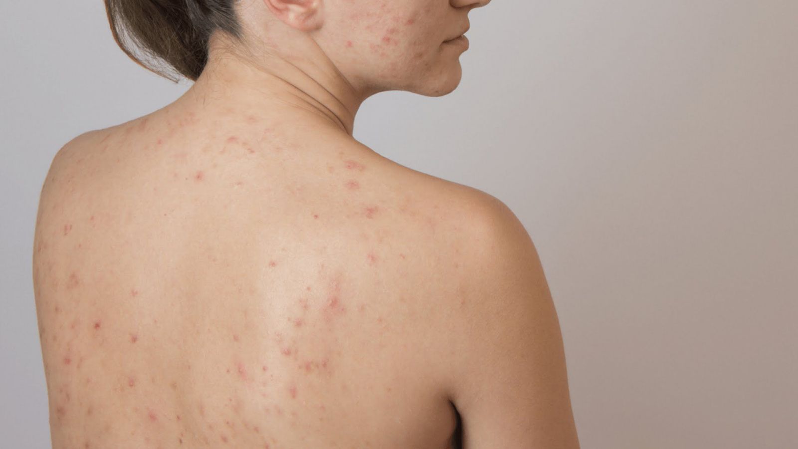 Vùng lưng của một người với làn da được chăm sóc, minh họa vấn đề mụn lưng